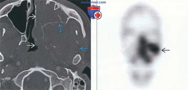 Рентгенограмма, КТ, сцинтиграфия при саркоме Юинга челюсти