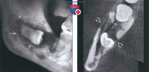 Лучевая диагностика центрального мукоэпидермиоидного рака челюсти