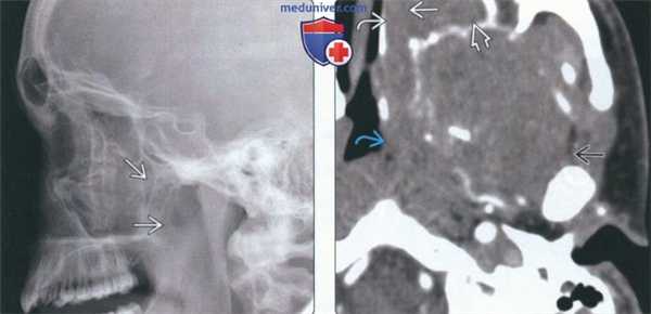 Рентгенограмма, КТ, сцинтиграфия при саркоме Юинга челюсти