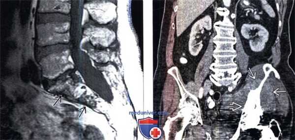 МРТ, КТ сцинтиграмма при болезни Педжета позвоночника