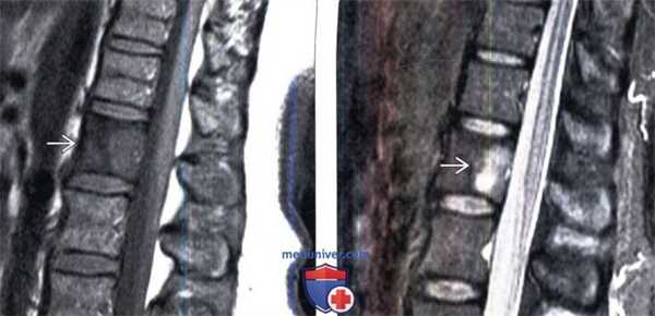 МРТ при болезни Педжета позвоночника