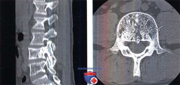 КТ при болезни Педжета позвоночника