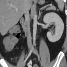 kidney agenesis