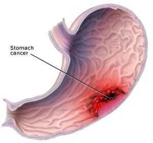 Лейомиома может переродиться в злокачественную опухоль