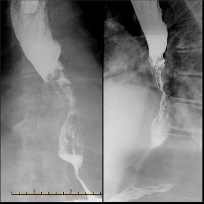 Рентгенодиагностика рака пищевода