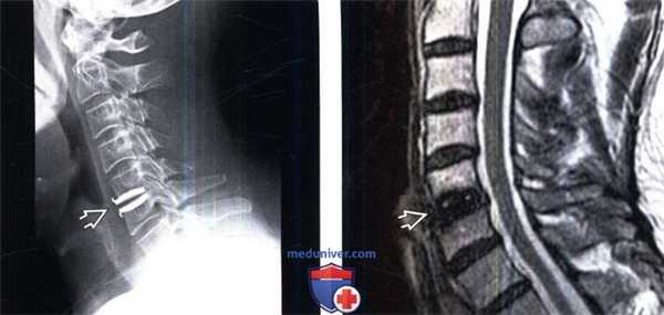 Рентгенограмма, МРТ искусственного шейного межпозвонкового диска