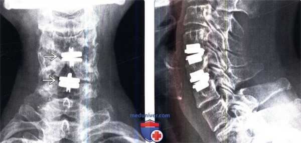 Рентгенограмма, МРТ искусственного шейного межпозвонкового диска