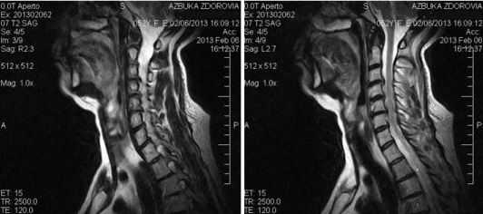 МРТ шейного отдела позвоночника