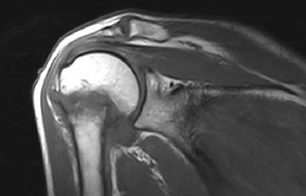 МРТ плечевого сустава в корональной плоскости