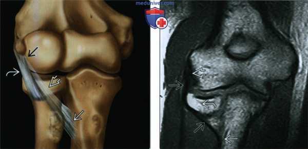 Признаки повреждения латеральной локтевой коллатеральной связки