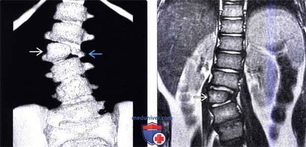 КТ, МРТ нарушения формирования позвонков