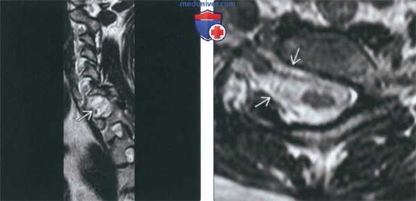 Рентгенограмма, КТ, МРТ при нарушении формирования шейного отдела позвоночника