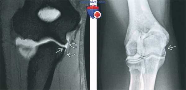 Признаки повреждения локтевой коллатеральной связки на артрограмме