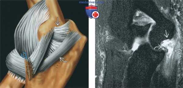 Признаки повреждения локтевой коллатеральной связки на артрограмме