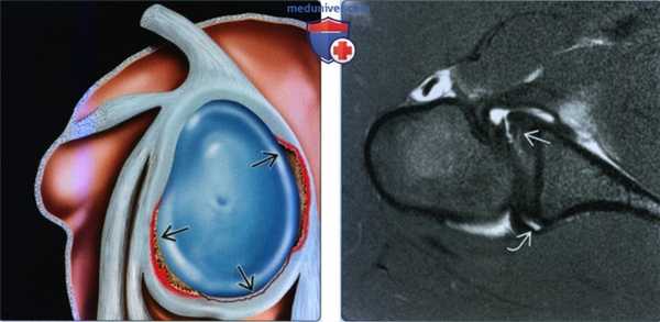 Признаки распространенного разрыва губы плечевого сустава