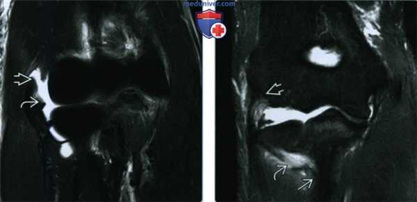Признаки повреждения латеральной локтевой коллатеральной связки