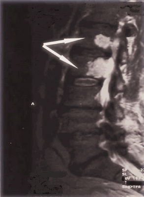 МРТ снимок позвоночника