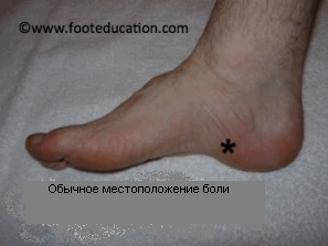 Основной участок боли подошвенной фасции