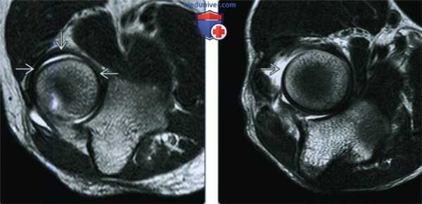 Признаки повреждения кольцевой связки локтевого сустава