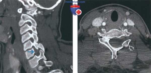 Рентгенограмма, КТ, МРТ при нарушении формирования шейного отдела позвоночника