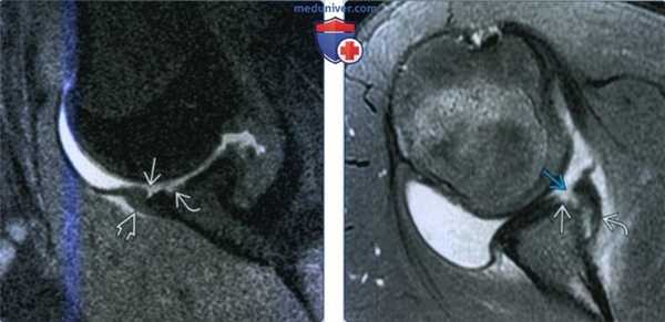 Признаки разрыва губы и/или края суставной впадины плечевого сустава