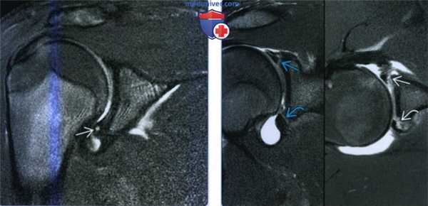 Признаки распространенного разрыва губы плечевого сустава