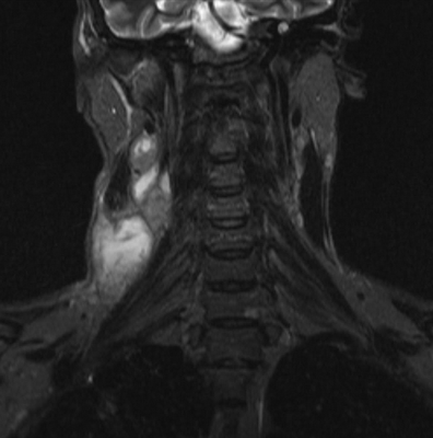 Магнитно-резонансное сканирование: киста правой почки (стрелка)