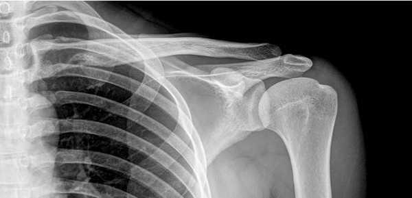 Рентгенограмма плечевого сустава