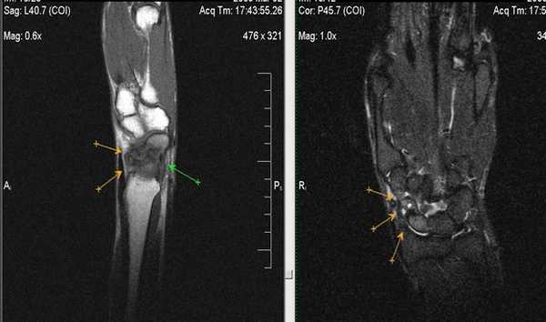 МРТ кисти: когда назначается?