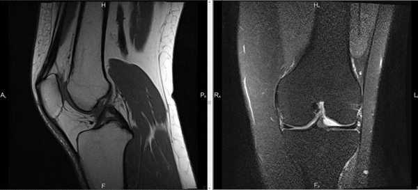 Снимок МРТ коленного сустава