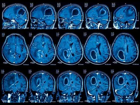 Опухоль на томограмме головного мозга