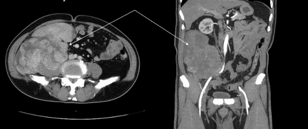 Гигантская опухоль забрюшинного пространства на КТ