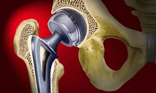 Эндопротез может вызвать дефекты 