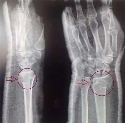 перелом лучевой кости в типичном месте