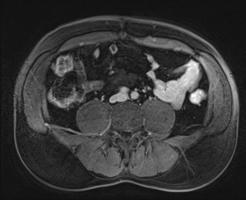 МРТ: ретроперитонеальная лимфангиома