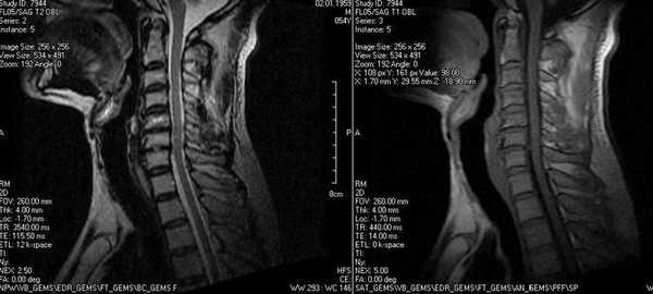 МРТ мягких тканей шеи