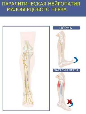 Провисание стопы при нейропатии малоберцового нерва