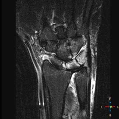 МРТ кисти: когда назначается?