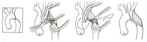 Коарктация аорты