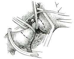 Коарктация аорты