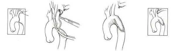 Коарктация аорты