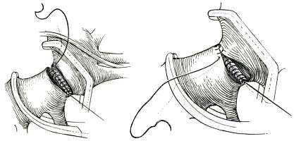 Коарктация аорты