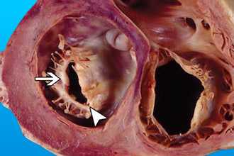 Хирургическое вмешательство при стенозе митрального клапана
