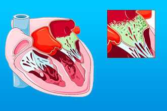 Ревмокардит