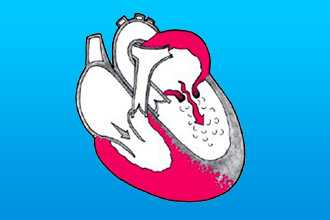 Что такое митральный стеноз