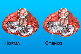 Стеноз митрального клапана