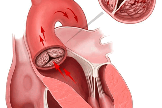 Митральный стеноз: причины и последствия болезни