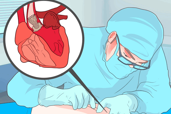 Митральный стеноз: причины и последствия болезни