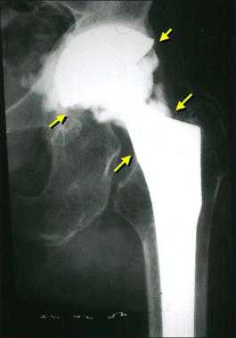инфекция эндопротеза