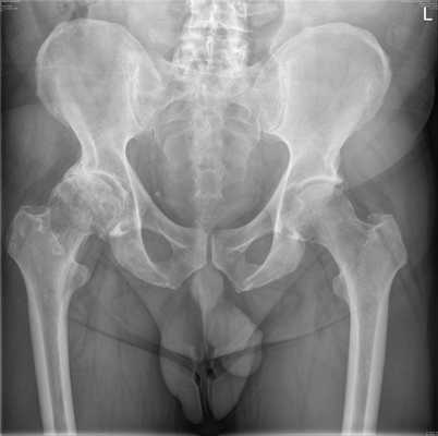 Некроз тазобедренного сустава